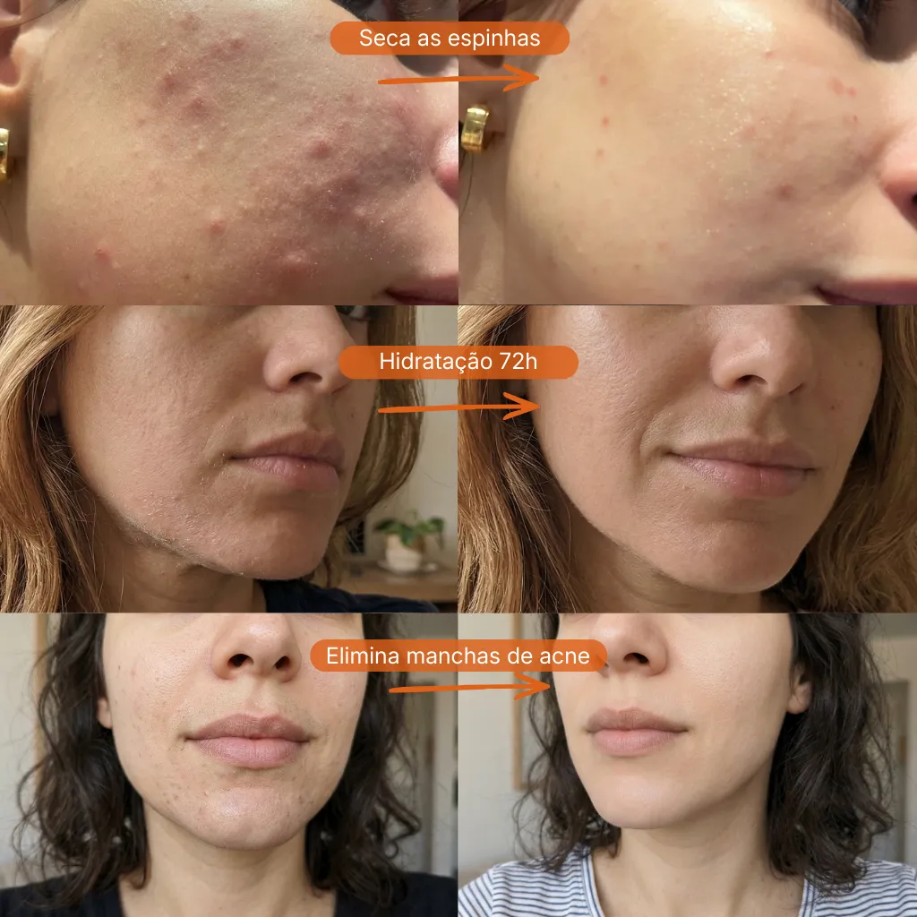 Sérum Antiacne Puraderme — antes e depois