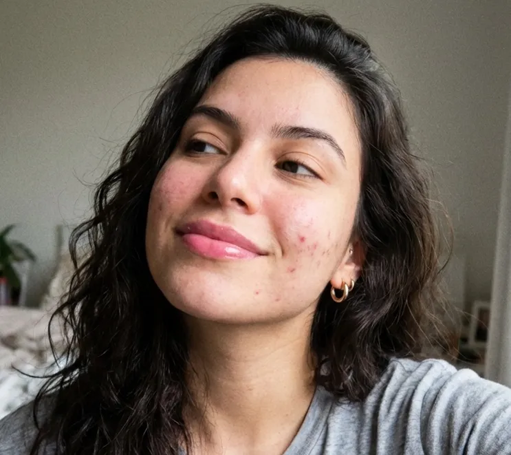 Resultado após 24h de uso do Sérum Antiacne Puraderme — pele matificada e poros desobstruídos