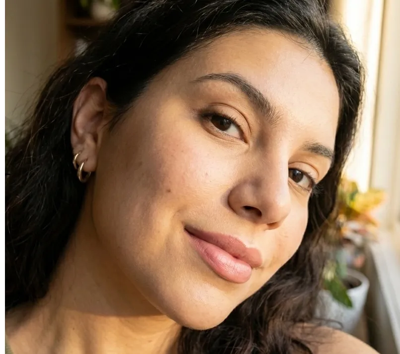 Resultado após 7 dias de uso do Sérum Antiacne Puraderme — pele equilibrada, manchas reduzidas e acne controlada