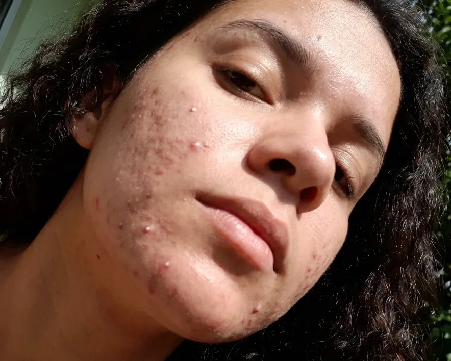 Tatiane L. — antes